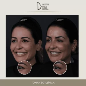 Depois do Botox: toxina botulinica