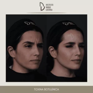 Antes e Depois do Botox: toxina botulinica