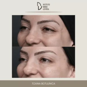 Resultados de aplicação botox