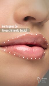 Preenchimento labial antes e depois