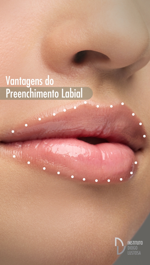 Preenchimento labial antes e depois