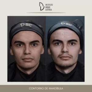 Antes e depois Harmonização facial masculina