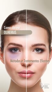 Como Clarear Olheiras: Métodos e Tratamentos Eficazes