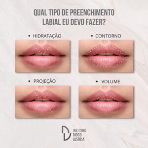 preenchimento labial, quais os tipos devo fazer?