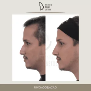 harmonização facial