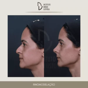 harmonização facial